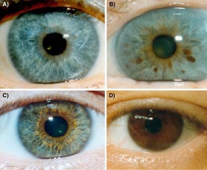 Различные варианты цвета глаз: a) голубые (отсутствие пигмента) b) голубые с вкраплениями карего c) зелено-карие d) карие. Фото: Springerlink.com