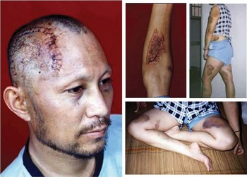 Следы пыток на телах последователей Фалуньгун, которым они подверглись в китайских тюрьмах и лагерях Фото: minghui.org
