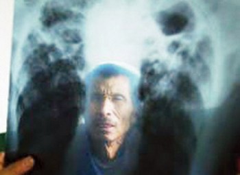 От запыления лёгких в Китае каждый год умирает шесть тысяч шахтёров