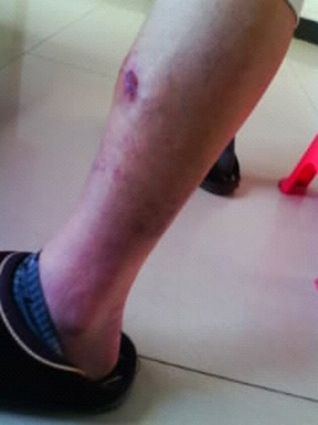 Рана на ноге последователя Фалуньгун, которую ему нанёс полицейский каблуком. Фото с minghui.org