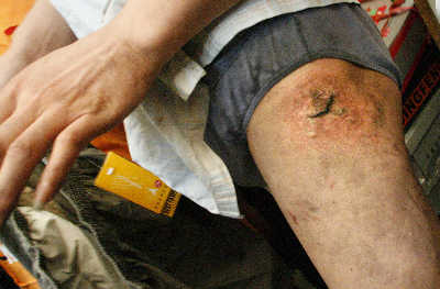  Рана на теле жителя города Гуанчжоу в результате взрыва мобильного телефона. 2007 год. Фото: Гуанчжоу Жибао