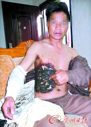 В результате взрыва мобильного телефона житель города Гуанчжоу получил сильные ожоги. 2009 год. Фото: Гуанчжоу Жибао