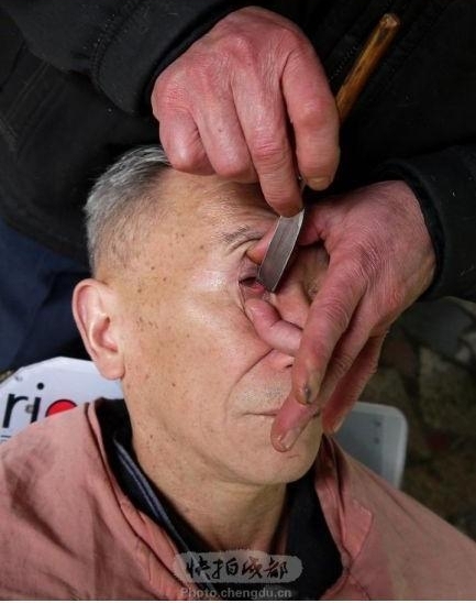 Чистка глаз ножом в Китае. Фото с epochtimes.com