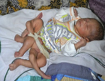 В Пакистане родился ребёнок с шестью ногами