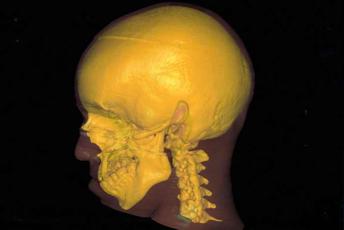 Мужчине заменили 75% черепа имплантатом