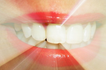Отбеливание зубов в домашних условиях. Фото: morguefile.com