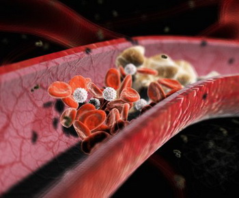 ЛПОНП и ЛПНП играют наибольшую роль в формировании атеросклеротических бляшек на сосудах, так как плохо проникаю через клеточную мембрану. Фото: 3D4Medical.com/Getty Images