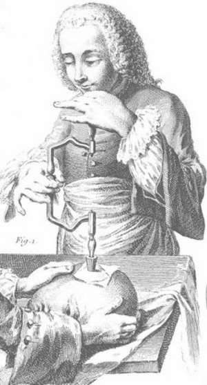 Сложные  операции трепанации человек выполнял в течение тысяч лет. Французская иллюстрация 18-го столетия Фото:  Wikimedia Commons 