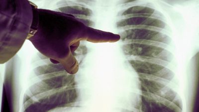 Рак лёгких можно заподозрить по температуре выдыхаемого воздуха