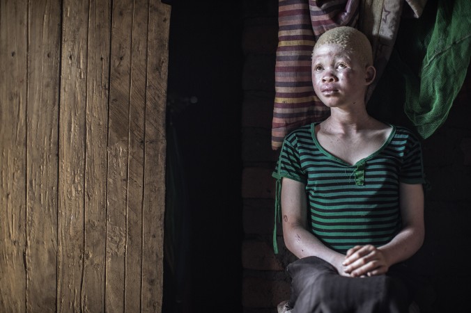 Кэтрин Амиду, 12-летняя девочка-альбинос, сидит у своего дома в районе Мачинга, 17 апреля 2015 г. Фото: Gianluigi Guercia/AFP/Getty Images | Epoch Times Россия