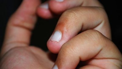 Грызть ногти — опасно для жизни! Мужчина, который чуть не умер из-за этой привычки, предупреждает