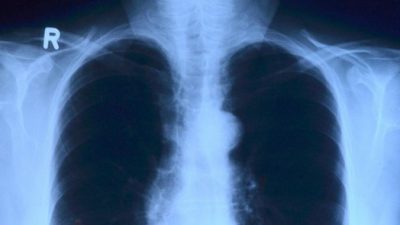Мини-лучевой рентген плечевого сустава ищите в питерских клиниках