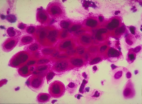 Раковые клетки в шейке матки. Фото: American Cancer Society/Getty Images | Epoch Times Россия