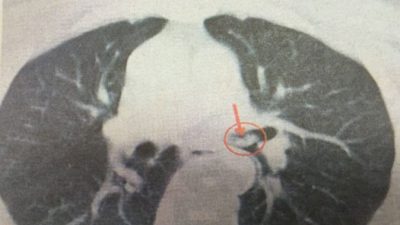 Китайский врач извлёк креветку из трахеи пациента