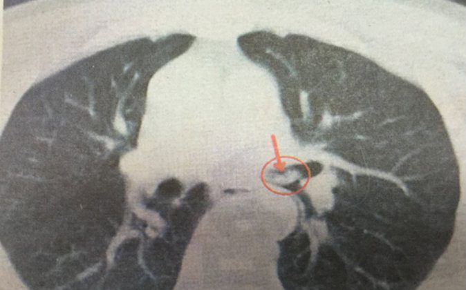 A CT scan of the man’s chest—his head is above the photograph, which shows his two lungs—illustrates where the shrimp is stuck in his trachea. (Qilu Evening News) | Epoch Times Россия