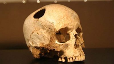 Трепанацию черепа делали в Китае более 3500 лет назад
