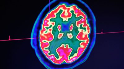 Учёные утверждают, что, возможно, открыли причину болезни Альцгеймера