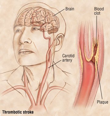 Церебральные тромботические инсульты — это инсульты, вызванные тромбом (сгустком крови), который развивается в артериях, снабжающих кровью головной мозг. (Изображение: через Drugs.com)