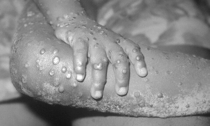 На фотографии 1971 года из памятки Центра по контролю за заболеваниями показаны похожие на обезьянью оспу поражения на руке и ноге ребёнка в Бондуа, Либерия. (CDC/Getty Images)
