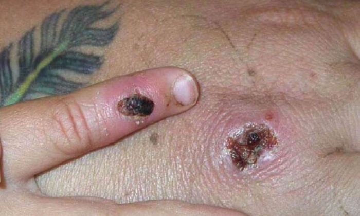 Симптомы одного из первых известных случаев заболевания вирусом обезьяньей оспы показаны на руке пациента 5 июня 2003 года. (CDC/Getty Images) | Epoch Times Россия