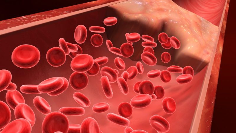 Сгусток крови, кальцинированное поражение, бляшка в артерии, ограничивающая кровоток.  Фото: BioMedical/Shutterstock  | Epoch Times Россия