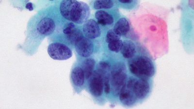 Новое открытие поможет усилить иммунотерапию раковых опухолей