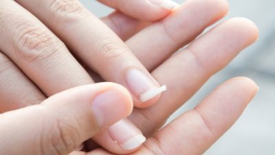 Восемь заболеваний ногтей и их значение для вашего здоровья