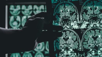 Ранняя диагностика болезни Альцгеймера по одному снимку мозга