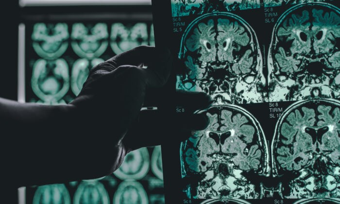 Сканирование мозга пациента с болезнью Альцгеймера. (Atthapon Raksthaput/Shutterstock) | Epoch Times Россия