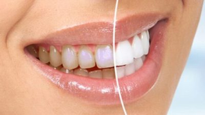 Спросите стоматолога: Отбеливание зубов