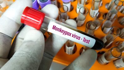 Вирус обезьяньей оспы: факты против страха