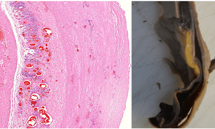 Трещина в стенке аорты, выстланная скоплениями лимфоцитов, приводящих к разрыву аорты. (Michael Palmer, MD, Suharit Bhakdi, MD) | Epoch Times Россия