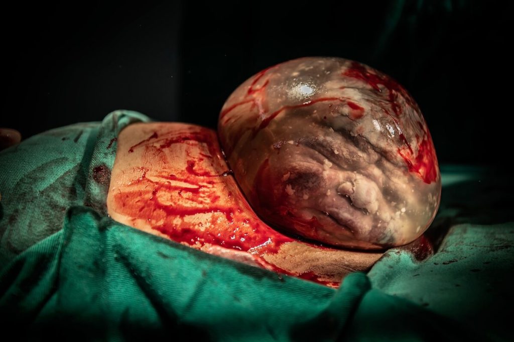 Редкие снимки рождения ребёнка путём кесарева сечения