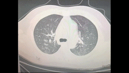 Компьютерная томография лёгких после появления гриппоподобных симптомов в середине декабря 2022 года. (The Epoch Times)