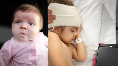 Девочка с гидроцефалией прозрела, научилась ходить и говорить, оставив врачей в недоумении