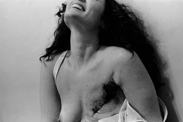 Доротея Линч, 34 года, смеётся на обследовании в Бостонской больнице, Массачусетс, 1979 год. В декабре прошлого года у нее диагностировали рак молочной железы, ранее она проходила лучевую терапию. Она рассмеялась на вопрос врача, чувствует ли она себя «ниже женщины» после мастэктомии. Фотография была частью серии под названием «Взрыв в жизнь: борьба с раком груди». (EugeneRichards/GettyImages)