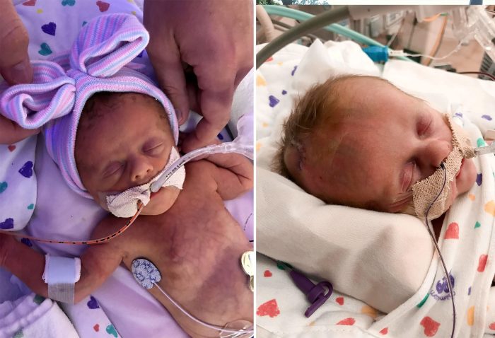 Близняшка спасла жизнь сестре, заставив врачей раньше принимать роды