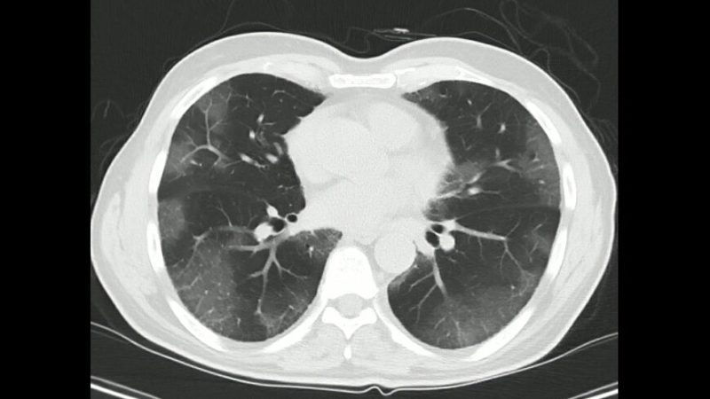 Компьютерная томография грудной клетки при подтверждённом случае COVID-19. (Shutterstock)
 | Epoch Times Россия