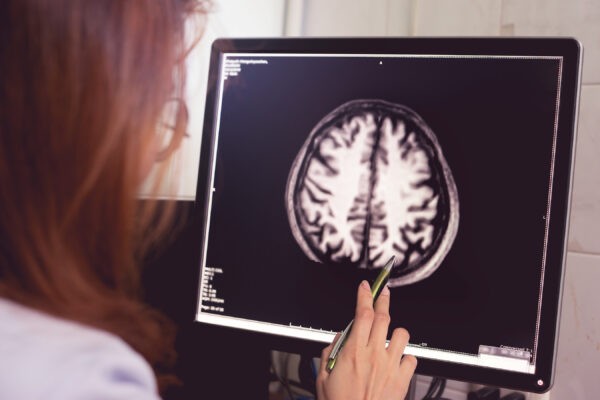 МРТ головного мозга пациента с деменцией с асимметрией атрофии левой теменной области. (Atthapon Raksthaput/Shutterstock)
