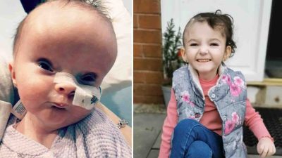 Девочка, родившаяся с увеличенной из-за болезни мозга головой, успешно справляется с недугом
