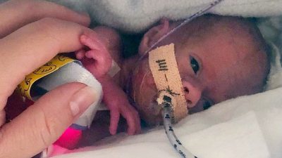 Мальчик родился слишком рано, чтобы жить… Но недавно он отпраздновал свой первый день рождения!