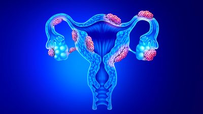 Новая версия причины эндометриоза даёт надежду на излечение