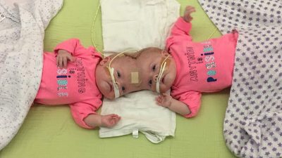 Врачи не ожидали, что разделённые близнецы смогут дожить до 7-летнего возраста