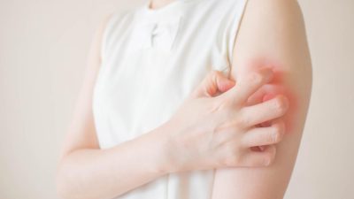 Длительный COVID вызывает кожную аллергию и зуд. Советы по облегчению симптомов