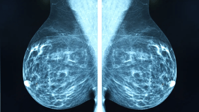 Станет ли искусственный интеллект новым инструментом для диагностики рака?