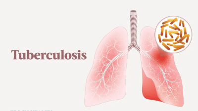 Туберкулёз: симптомы, причины, лечение, профилактика