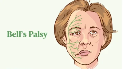 Паралич Белла: симптомы, причины, лечение и естественные подходы