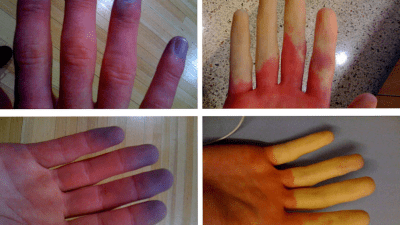 Пять упражнений для облегчения симптомов болезни Рейно