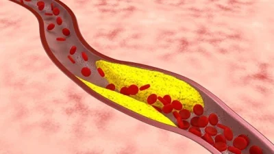 Ешьте меньше — простая, но сложная помощь при высоком уровне холестерина