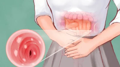 Язвенный колит: симптомы, причины, лечение и естественные подходы